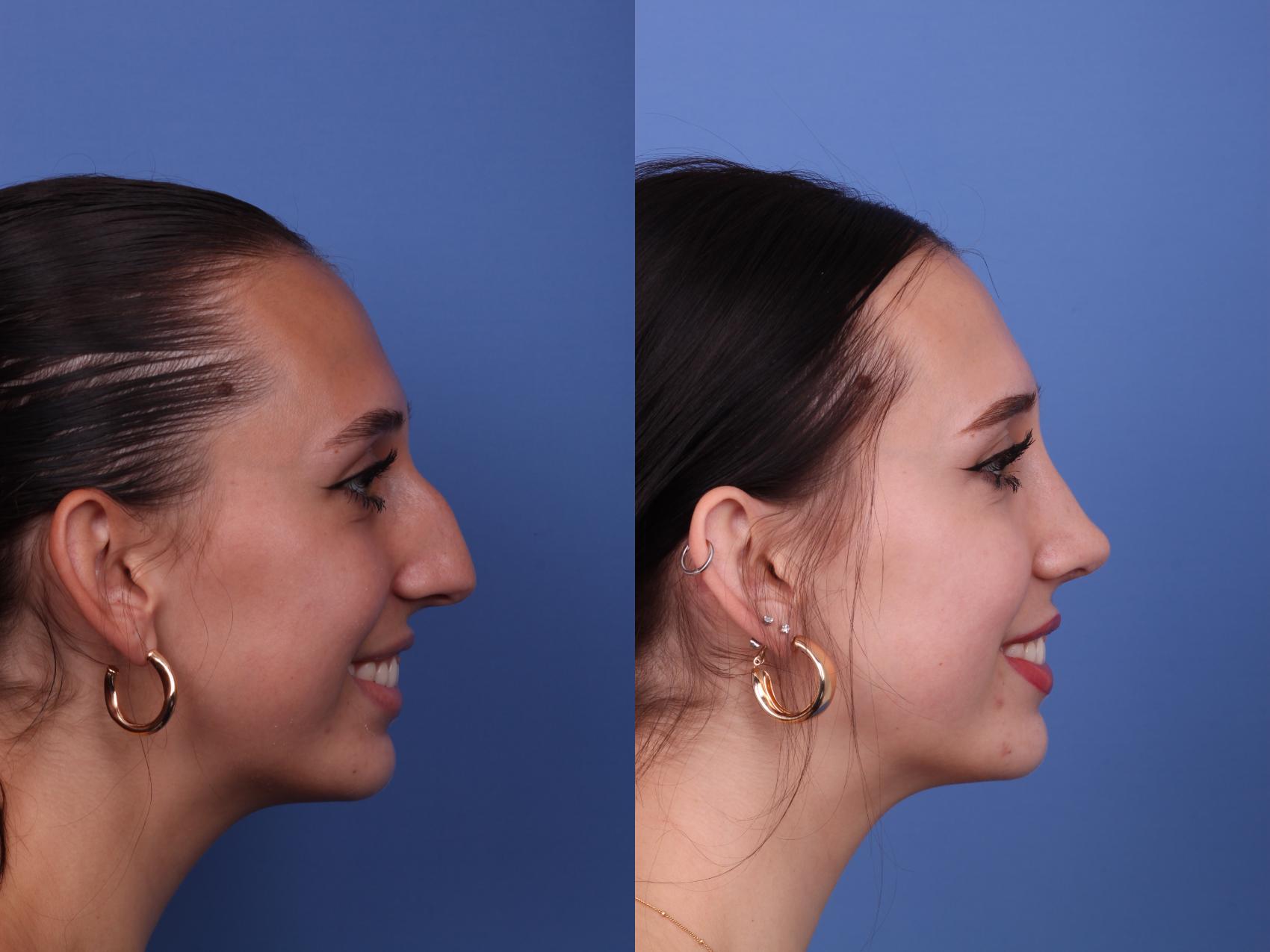 Before & After Rhinoplasty Case 540 Right Smile View in Scottsdale, AZ
