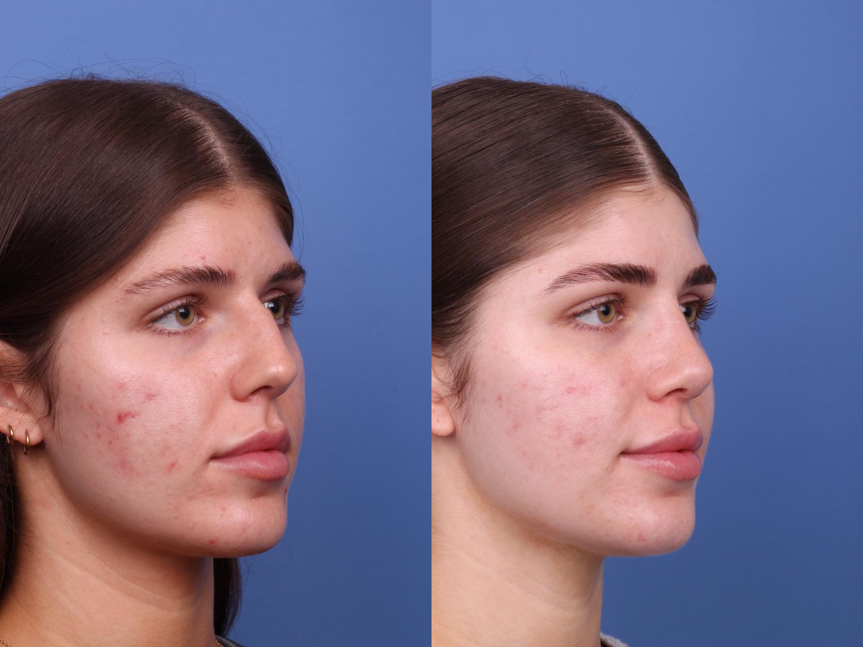 Before & After Rhinoplasty Case 541 Right Oblique View in Scottsdale, AZ