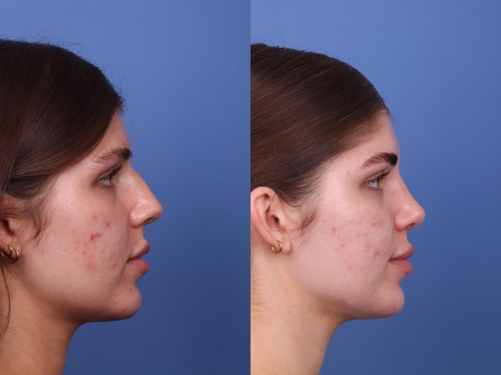 Before & After Rhinoplasty Case 541 Right Side View in Scottsdale, AZ