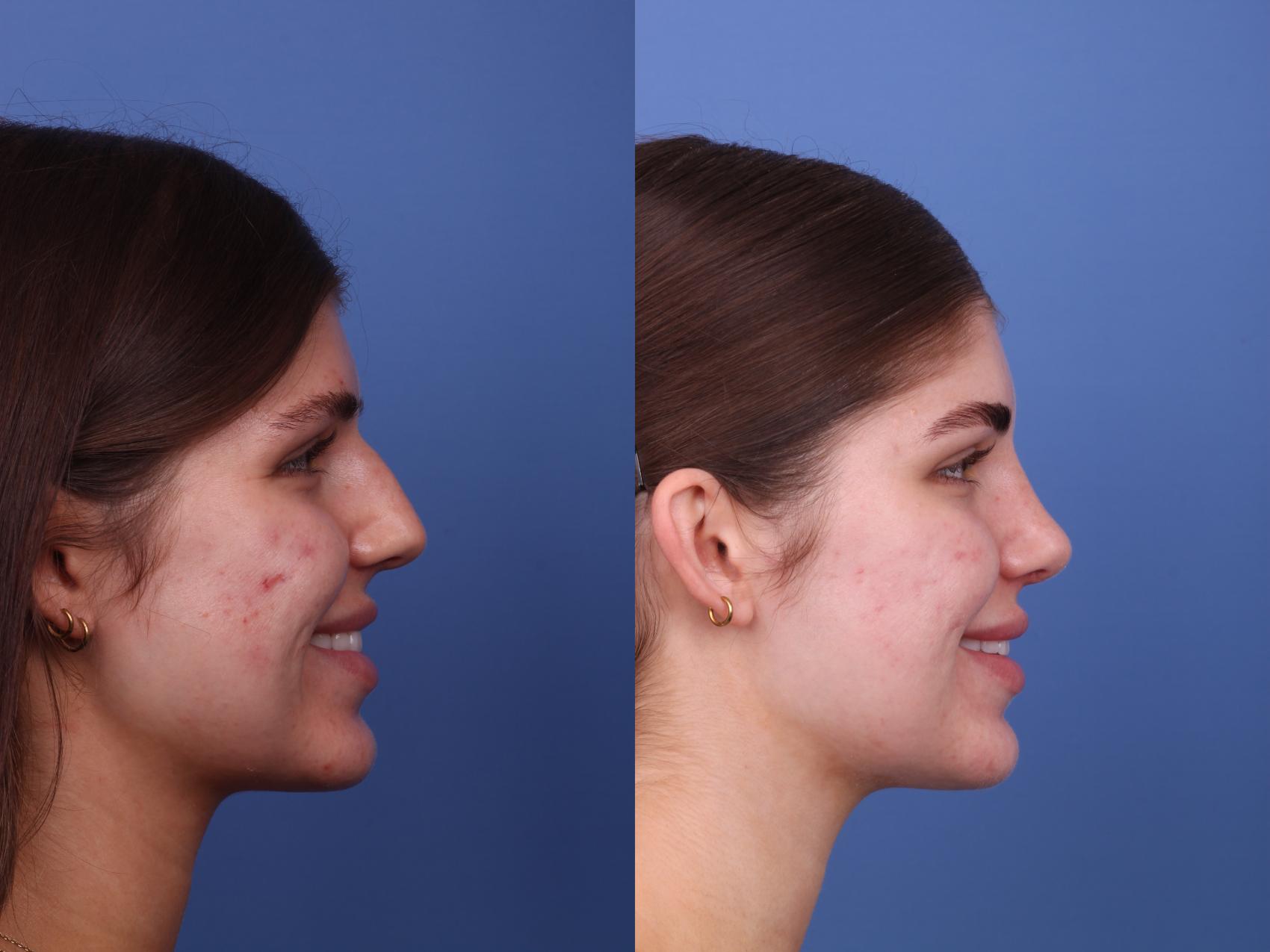 Before & After Rhinoplasty Case 541 Right Smile View in Scottsdale, AZ
