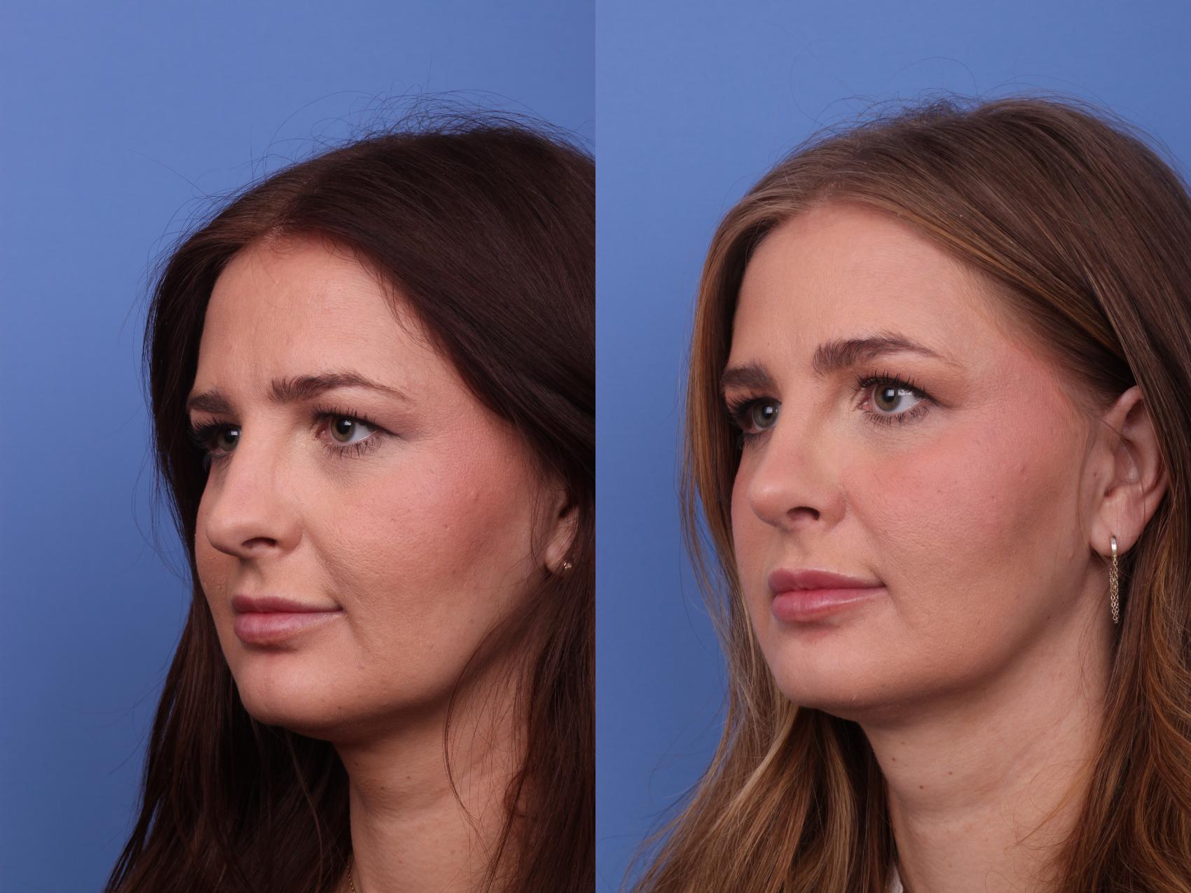 Before & After Rhinoplasty Case 548 Left Oblique View in Scottsdale, AZ