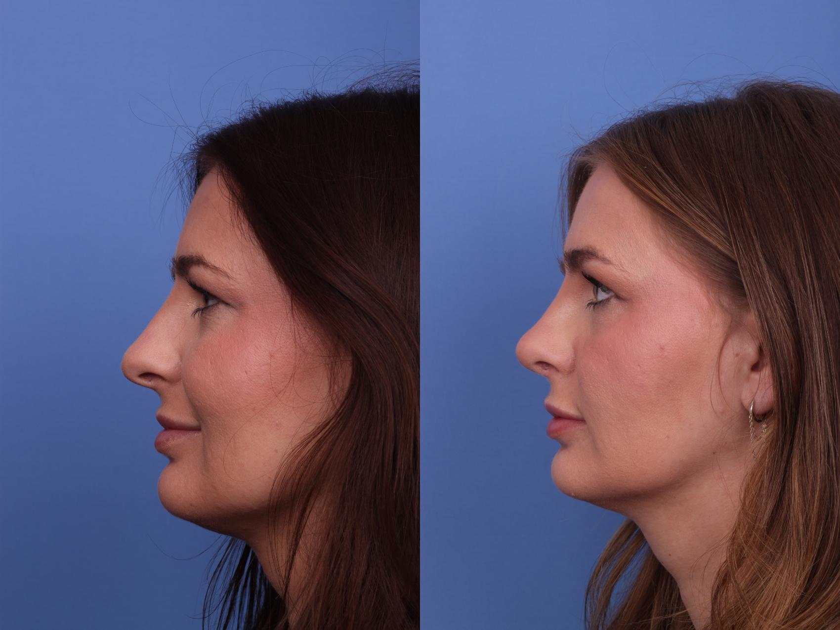 Before & After Rhinoplasty Case 548 Left Side View in Scottsdale, AZ