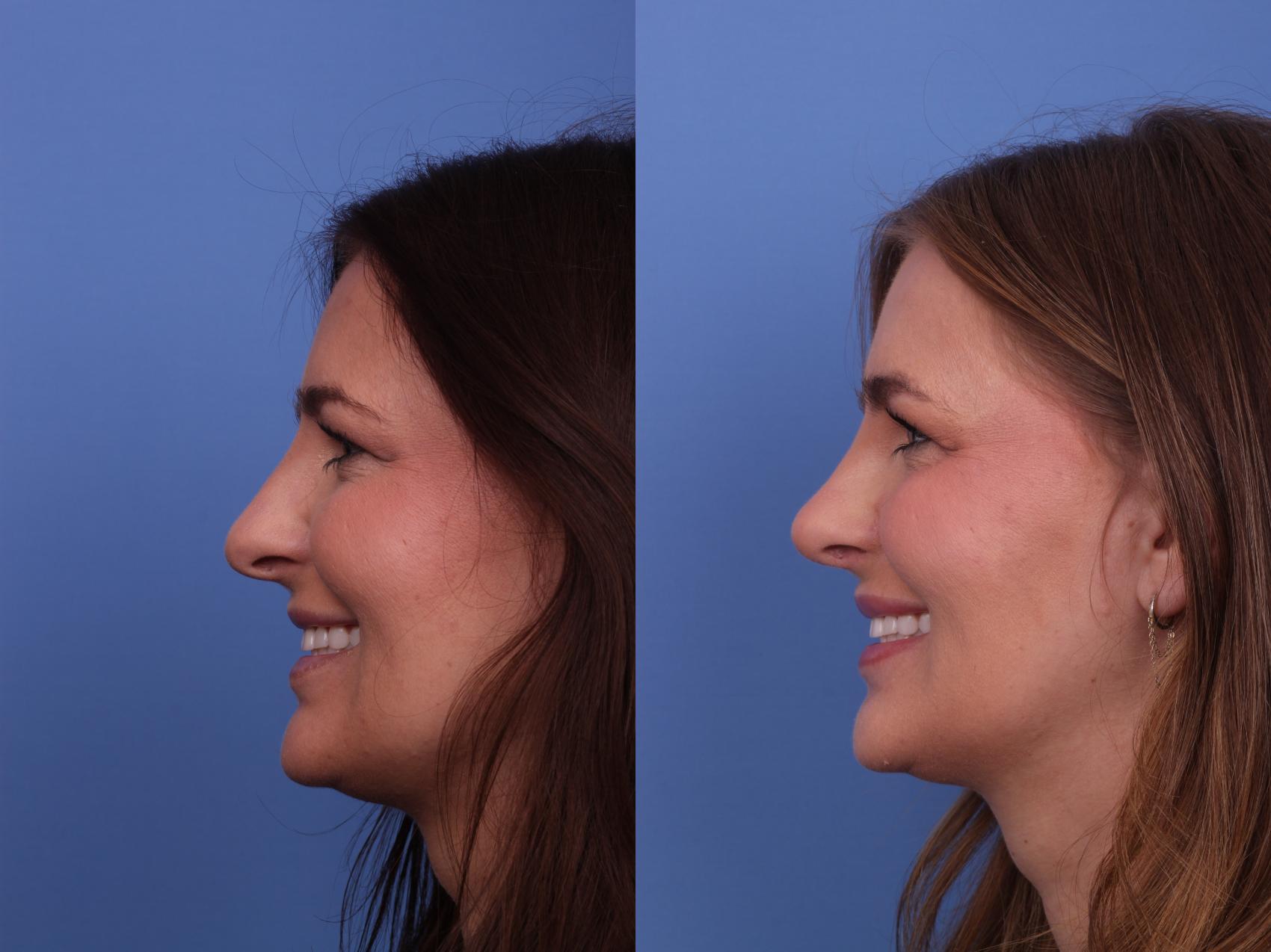 Before & After Rhinoplasty Case 548 Left Smile View in Scottsdale, AZ
