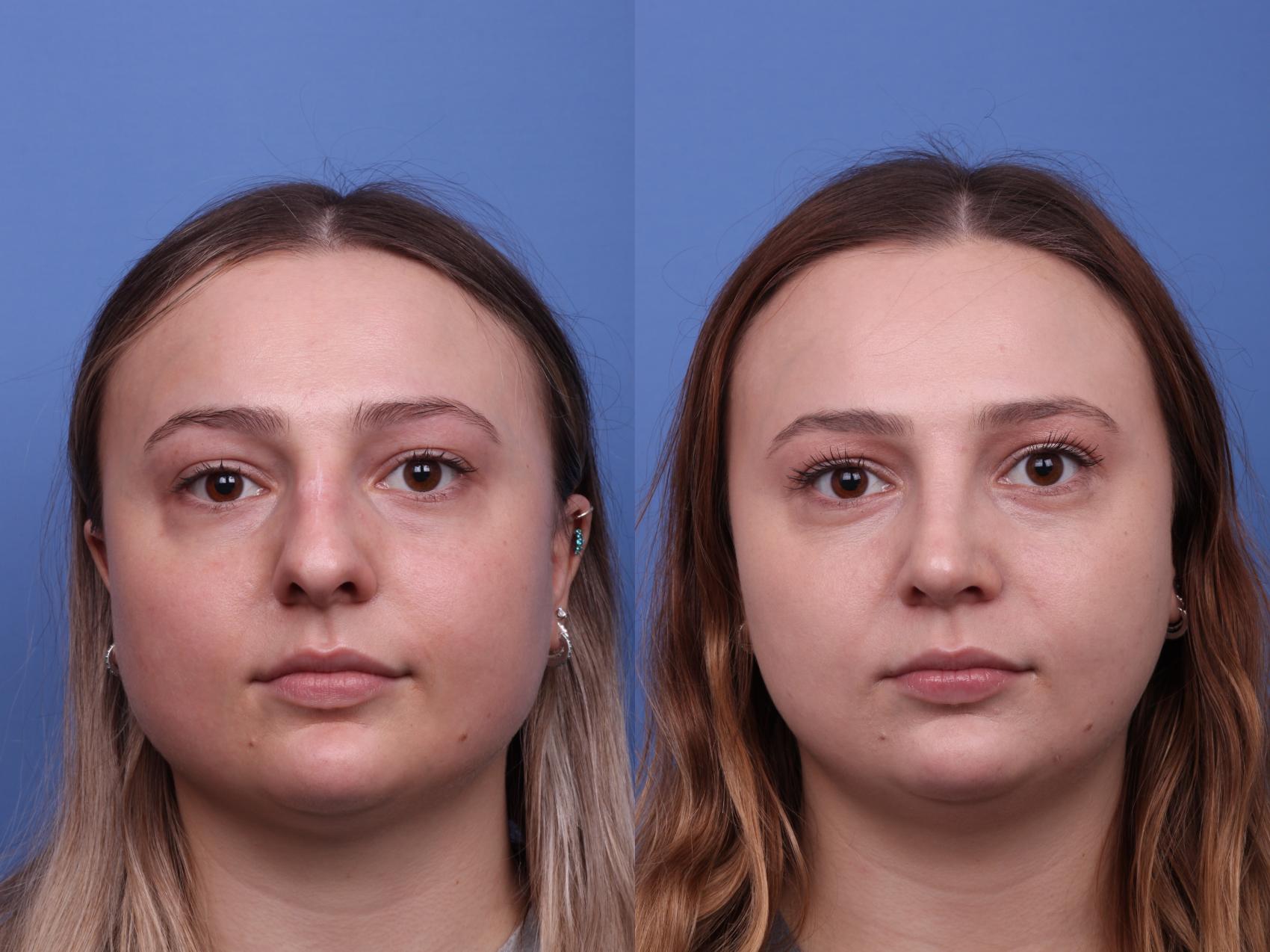 Before & After Rhinoplasty Case 549 Front View in Scottsdale, AZ