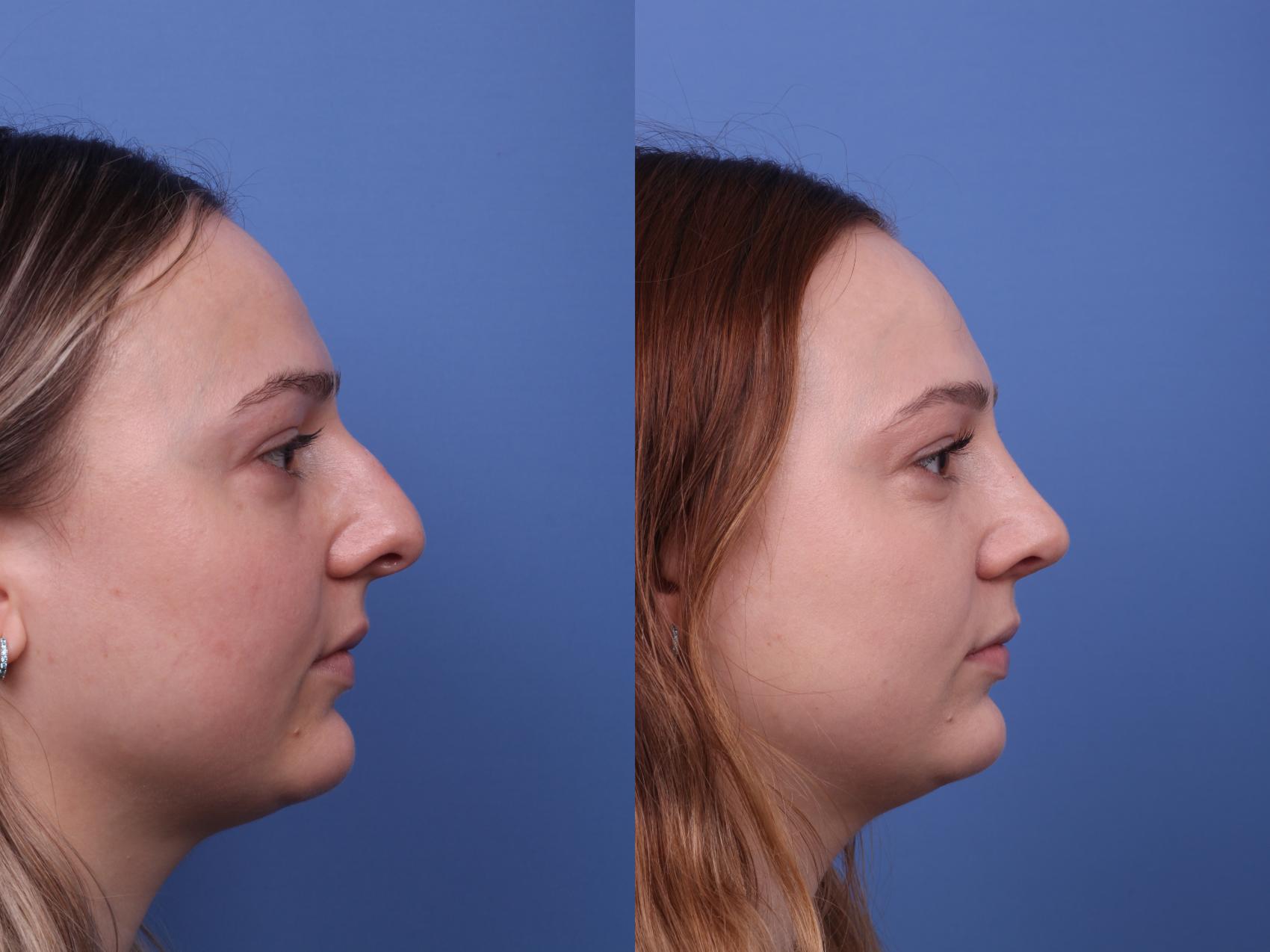 Before & After Rhinoplasty Case 549 Right Side View in Scottsdale, AZ