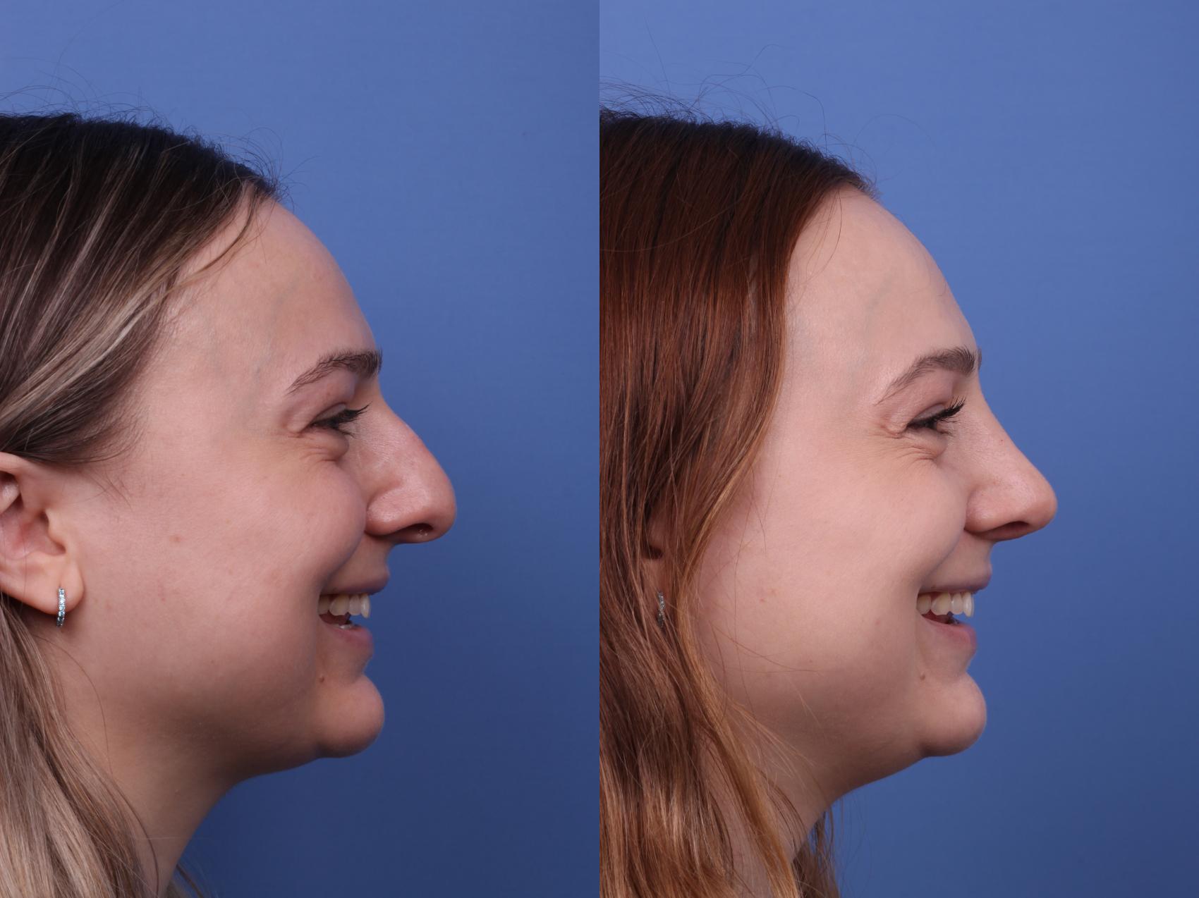 Before & After Rhinoplasty Case 549 Right Smile View in Scottsdale, AZ