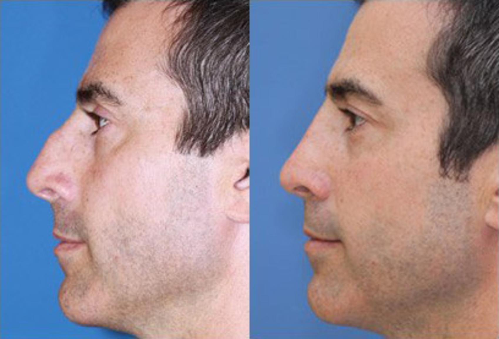 Before & After Rhinoplasty Case 55 View #2 View in Scottsdale, AZ