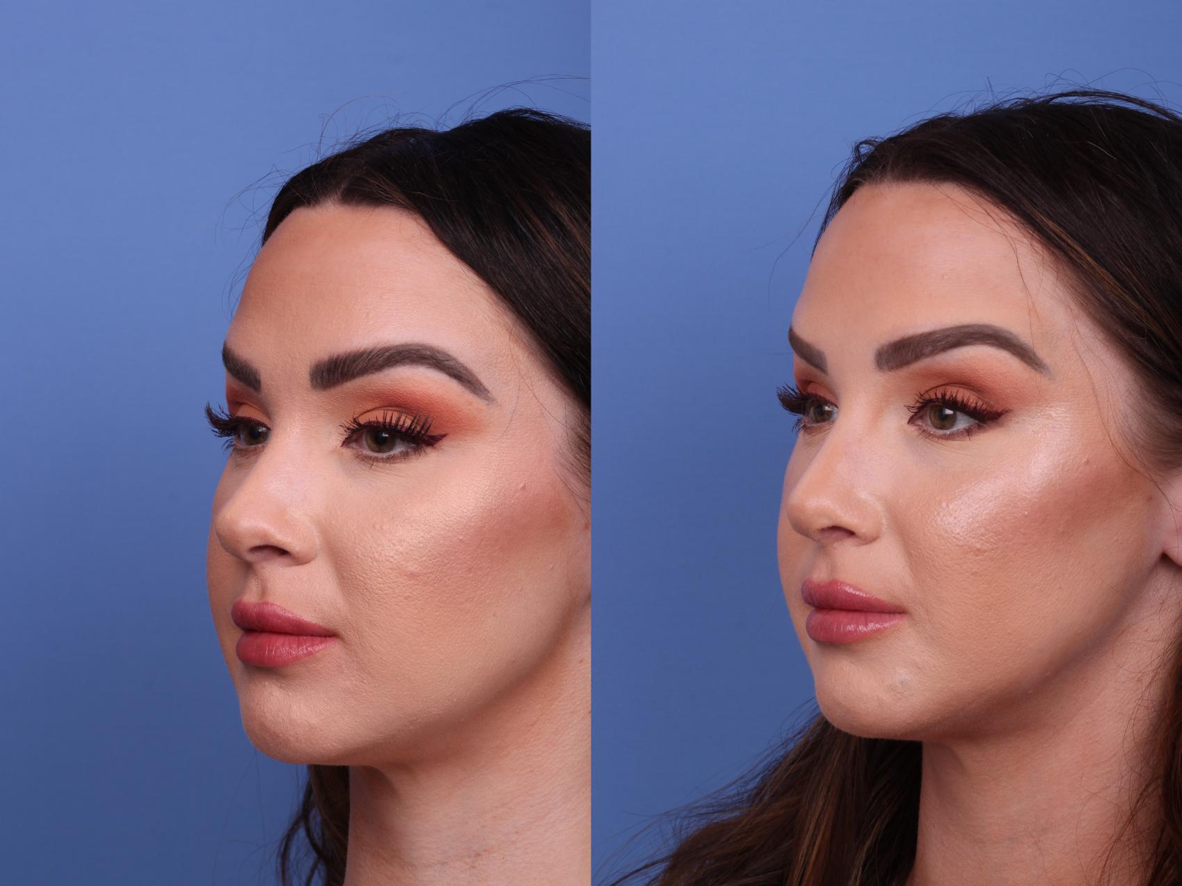 Before & After Rhinoplasty Case 552 Left Oblique View in Scottsdale, AZ