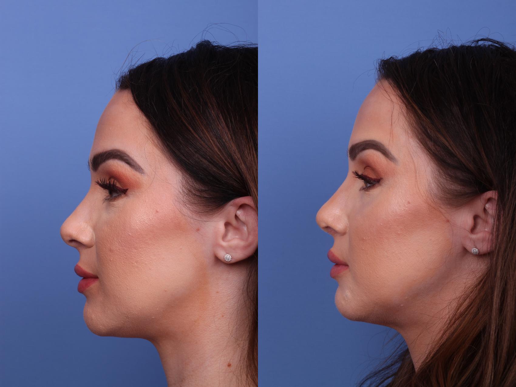 Before & After Rhinoplasty Case 552 Left Side View in Scottsdale, AZ