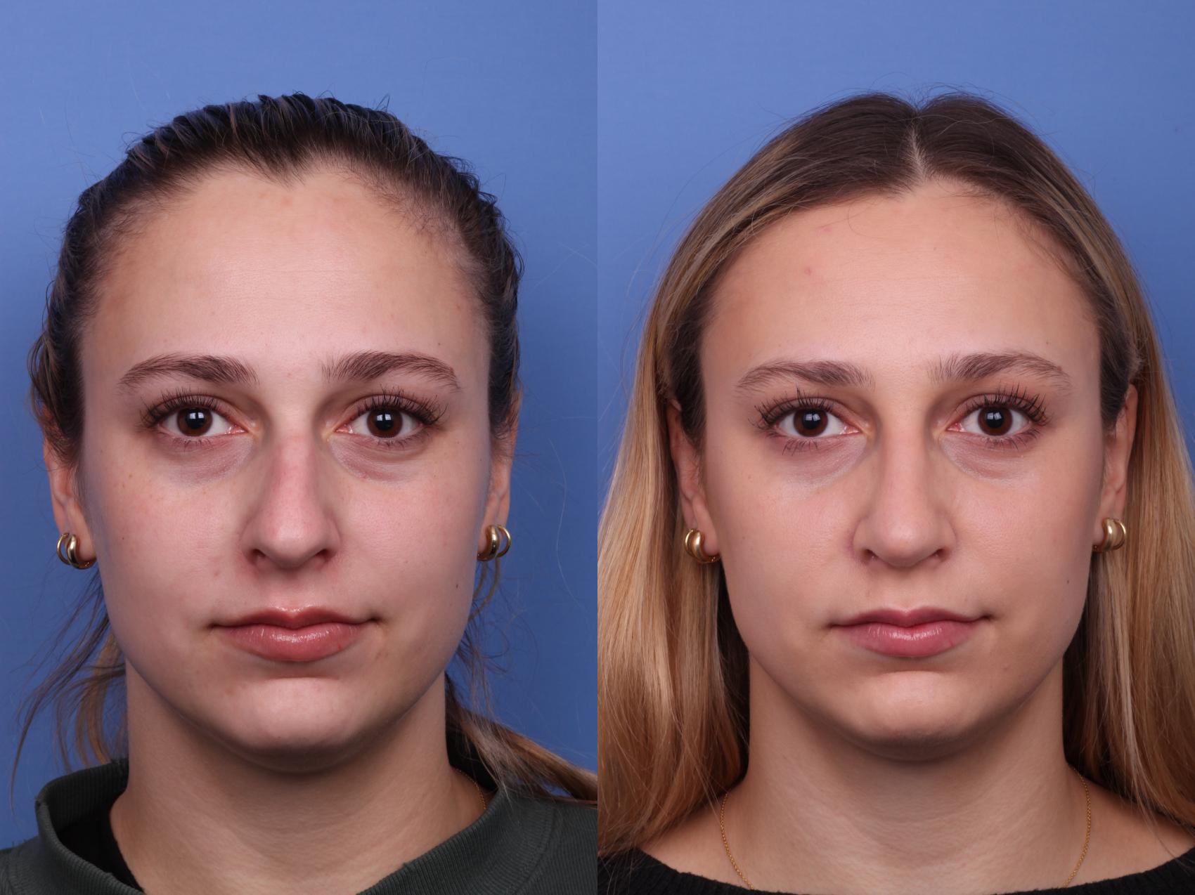 Before & After Rhinoplasty Case 553 Front View in Scottsdale, AZ