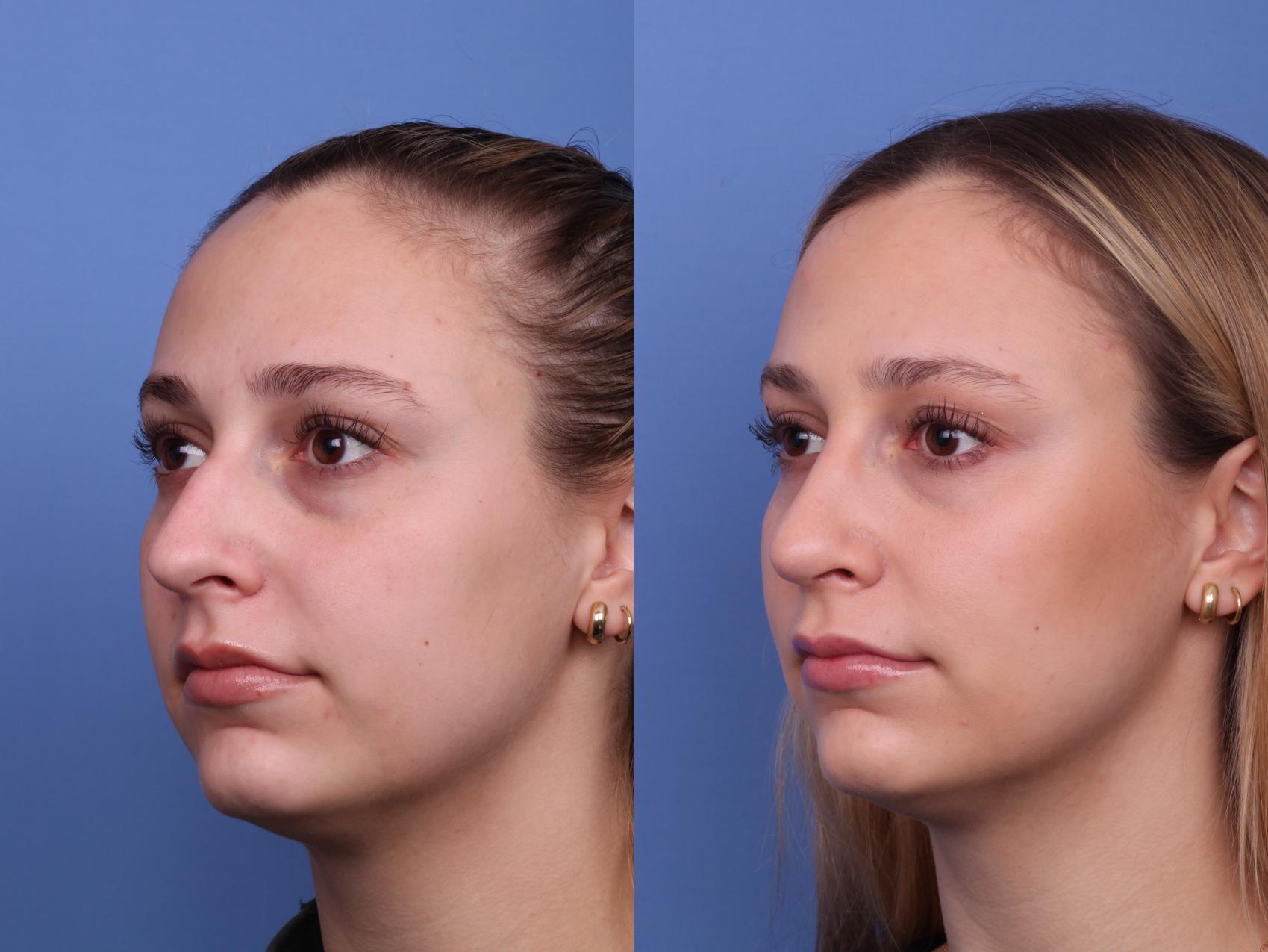 Before & After Rhinoplasty Case 553 Left Oblique View in Scottsdale, AZ