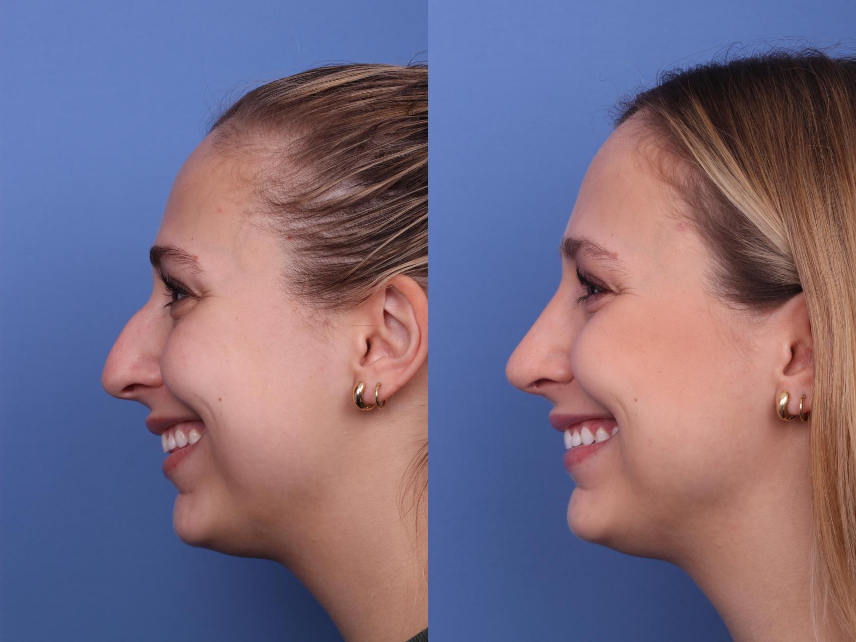 Before & After Rhinoplasty Case 553 Left Smile View in Scottsdale, AZ