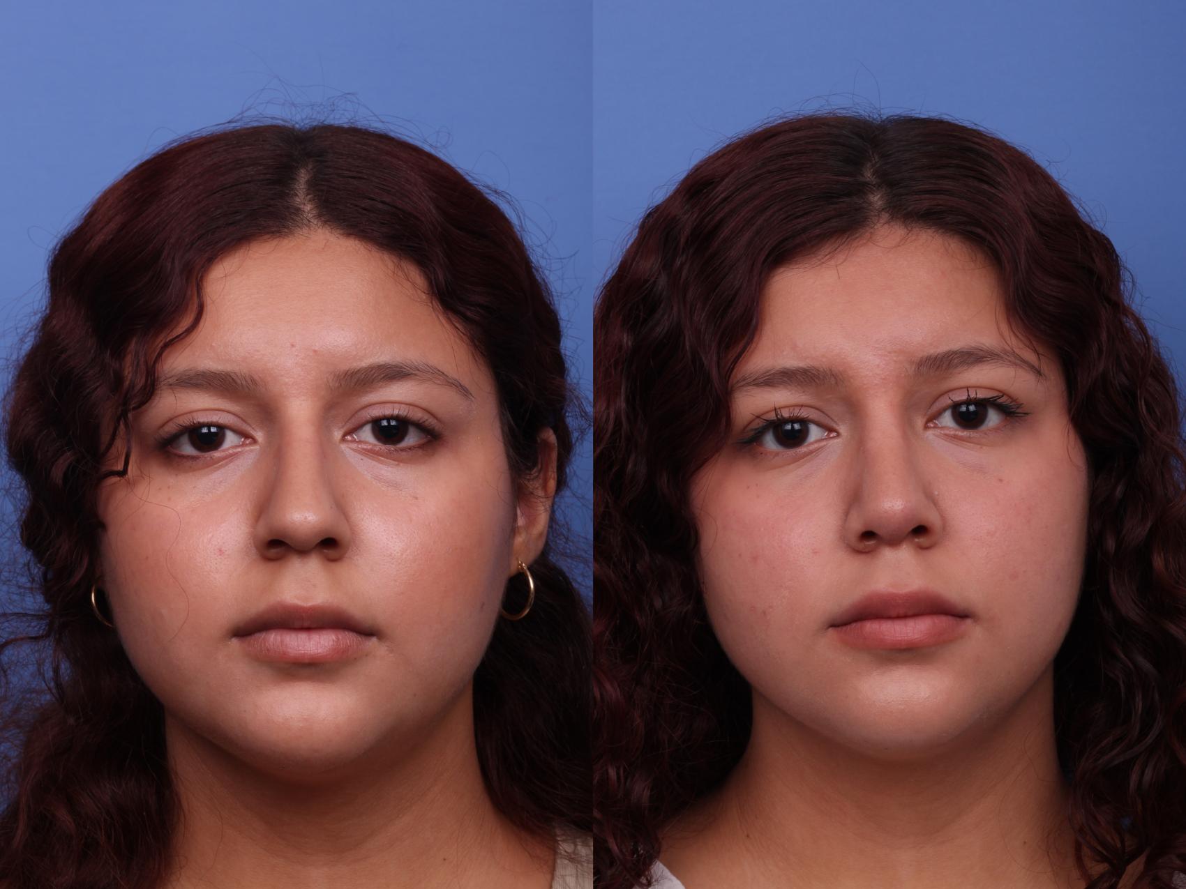Before & After Rhinoplasty Case 554 Front View in Scottsdale, AZ