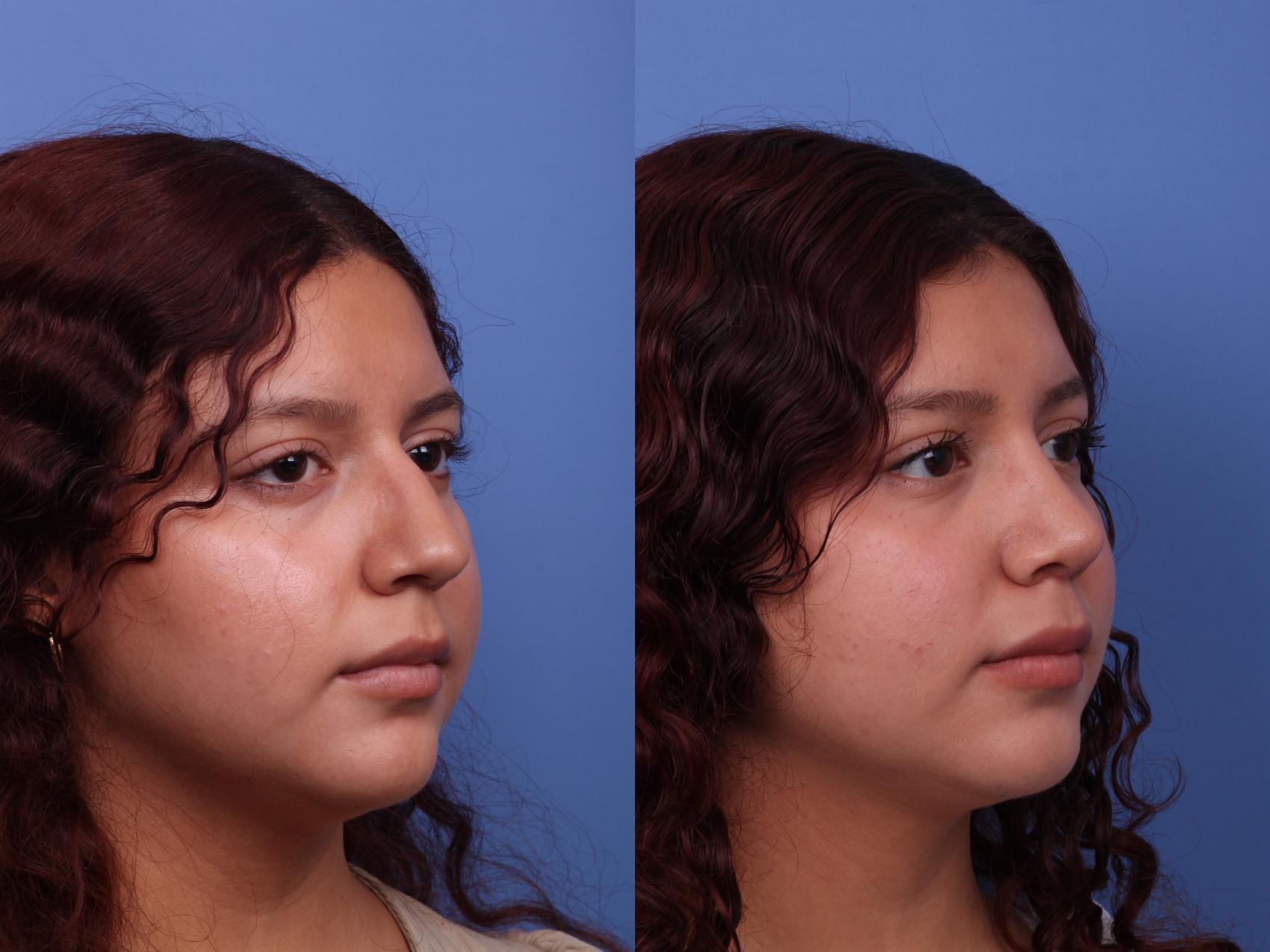 Before & After Rhinoplasty Case 554 Right Oblique View in Scottsdale, AZ