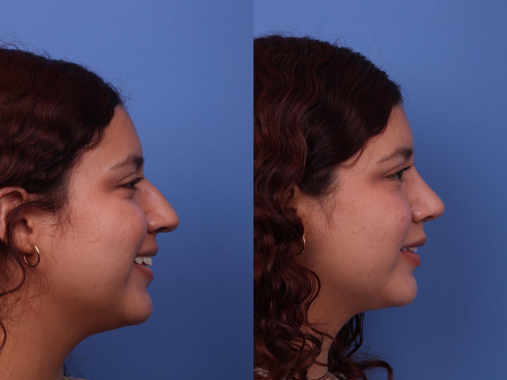 Before & After Rhinoplasty Case 554 Right Smile View in Scottsdale, AZ