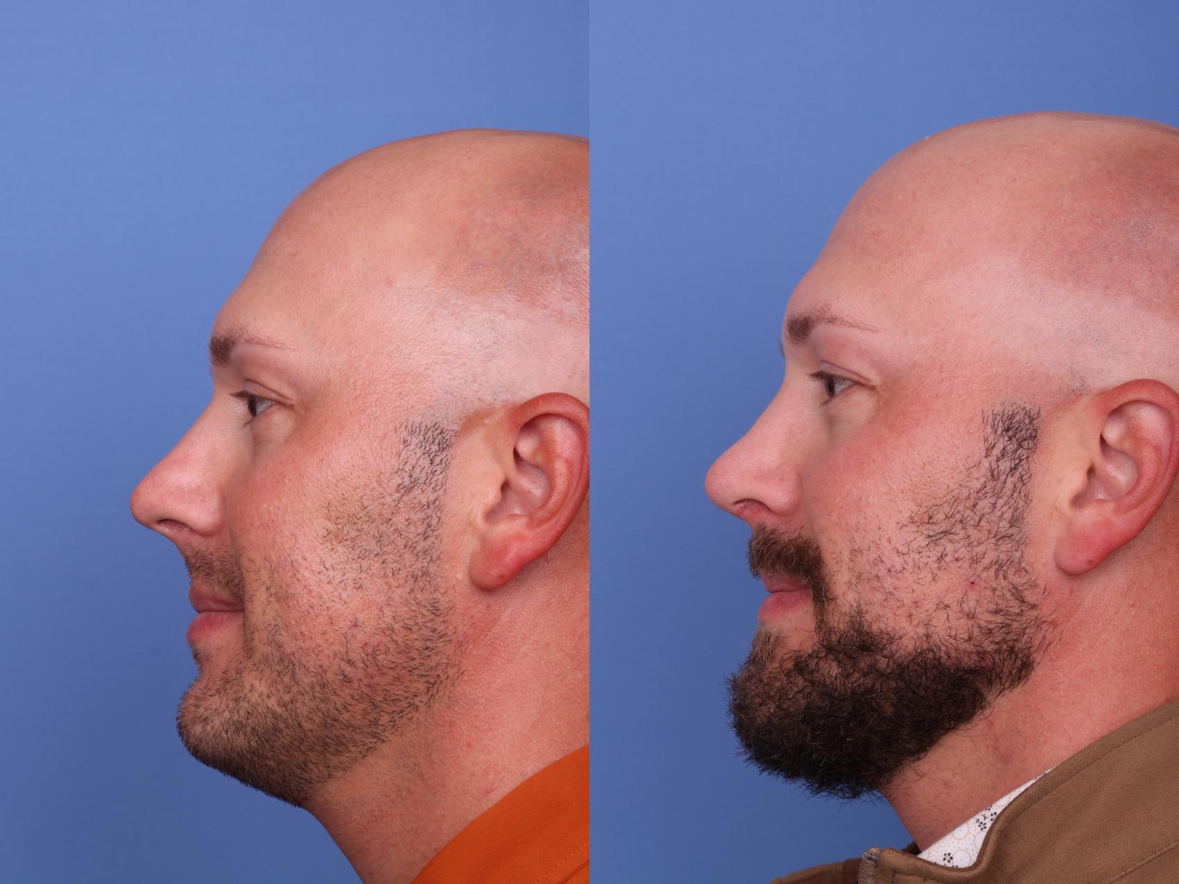 Before & After Rhinoplasty Case 555 Left Side View in Scottsdale, AZ