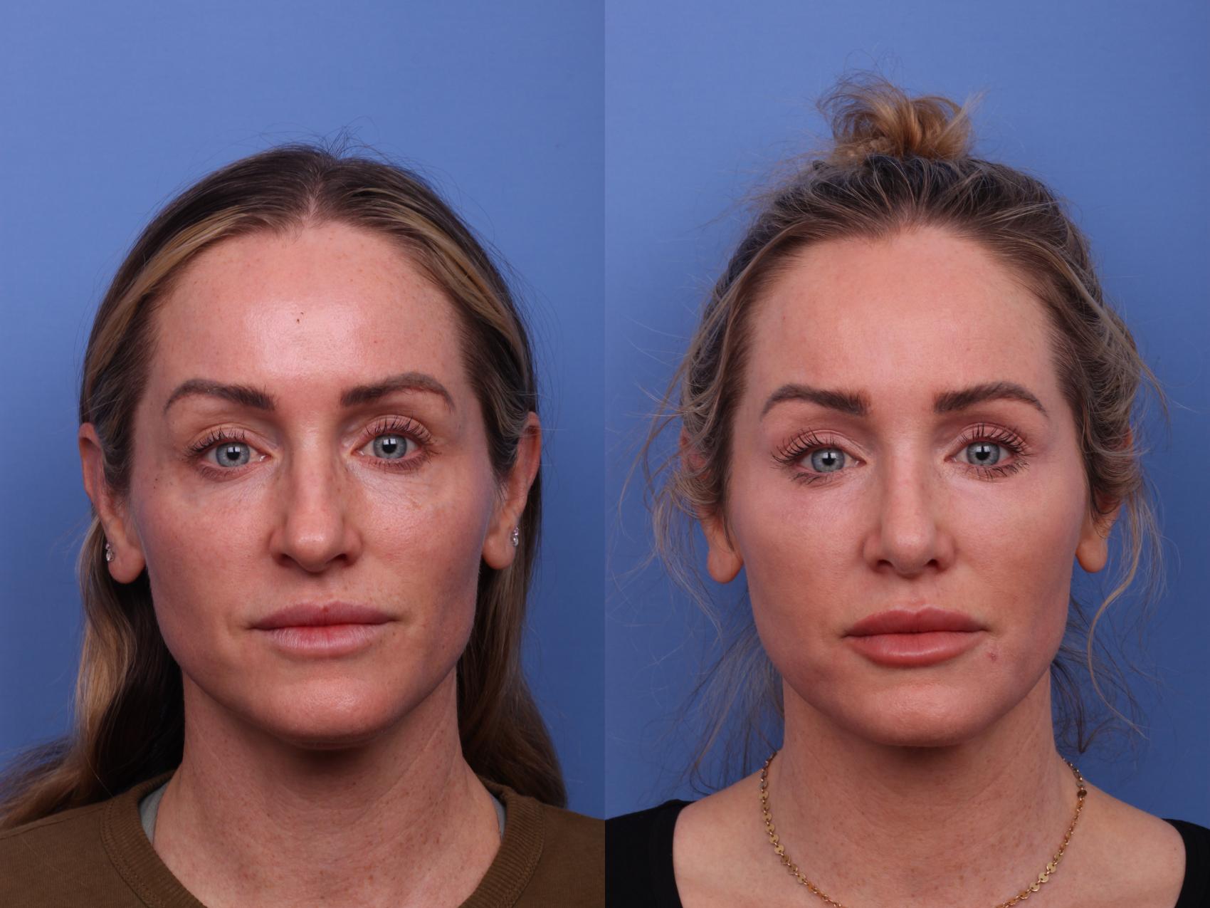 Before & After Rhinoplasty Case 556 Front View in Scottsdale, AZ