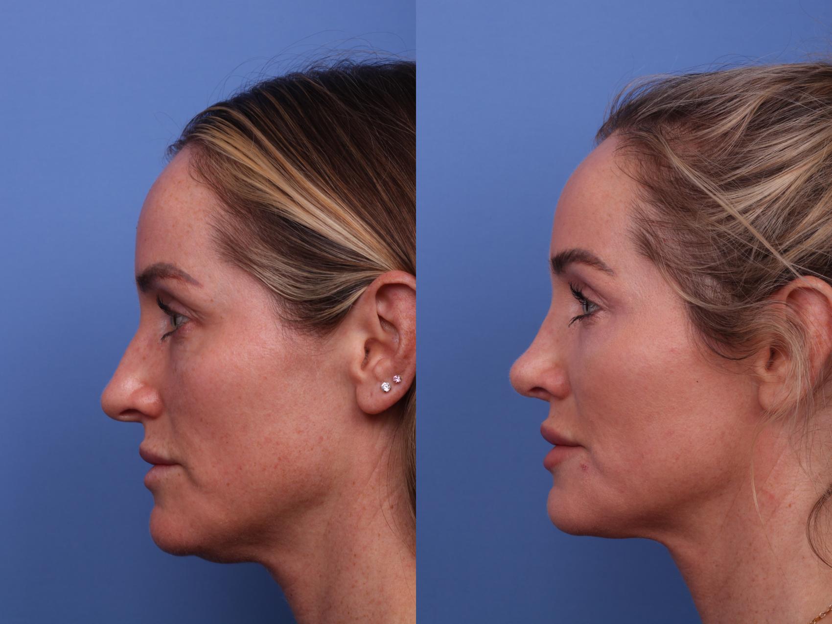 Before & After Rhinoplasty Case 556 Left Side View in Scottsdale, AZ