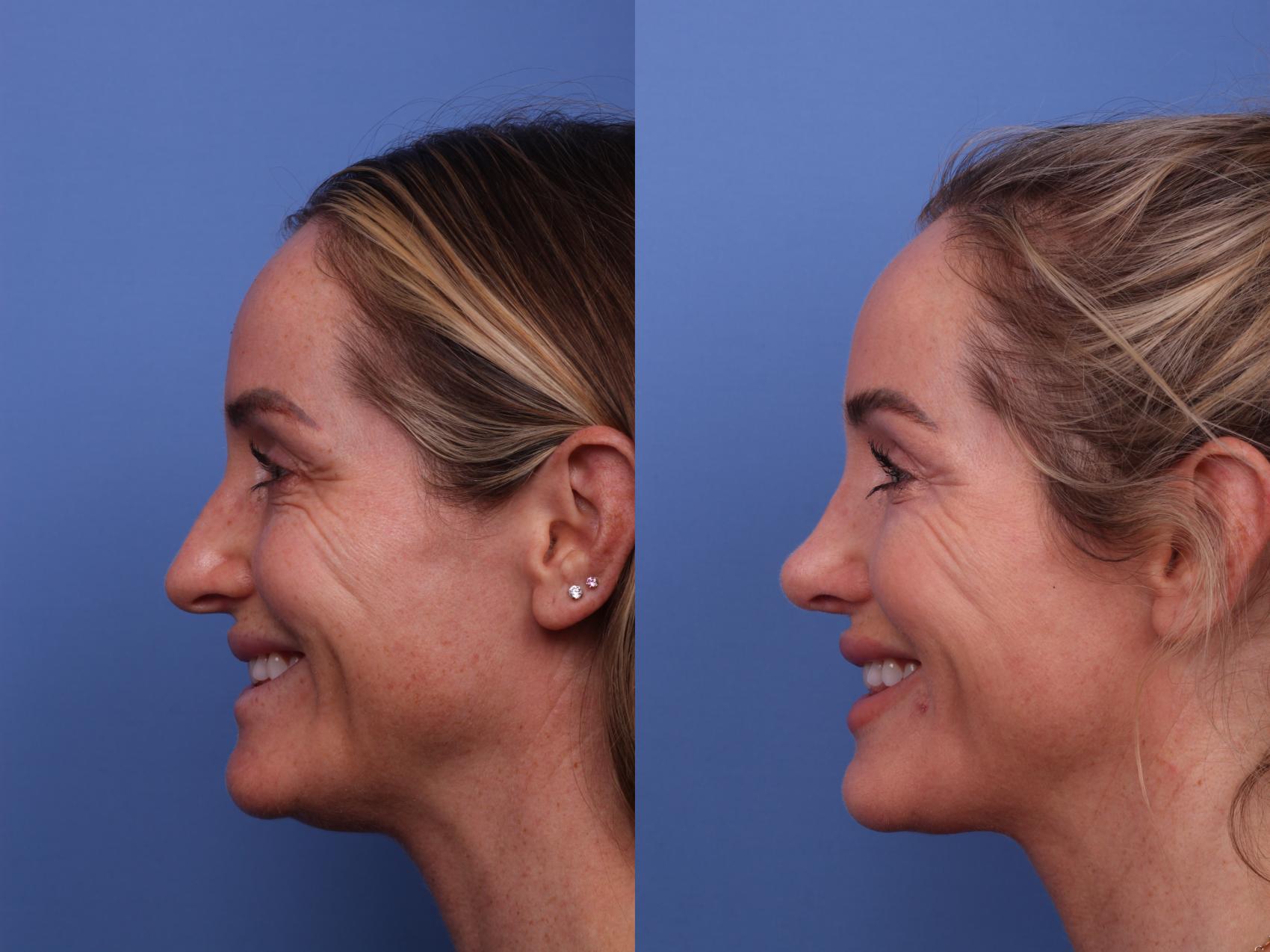 Before & After Rhinoplasty Case 556 Left Smile View in Scottsdale, AZ