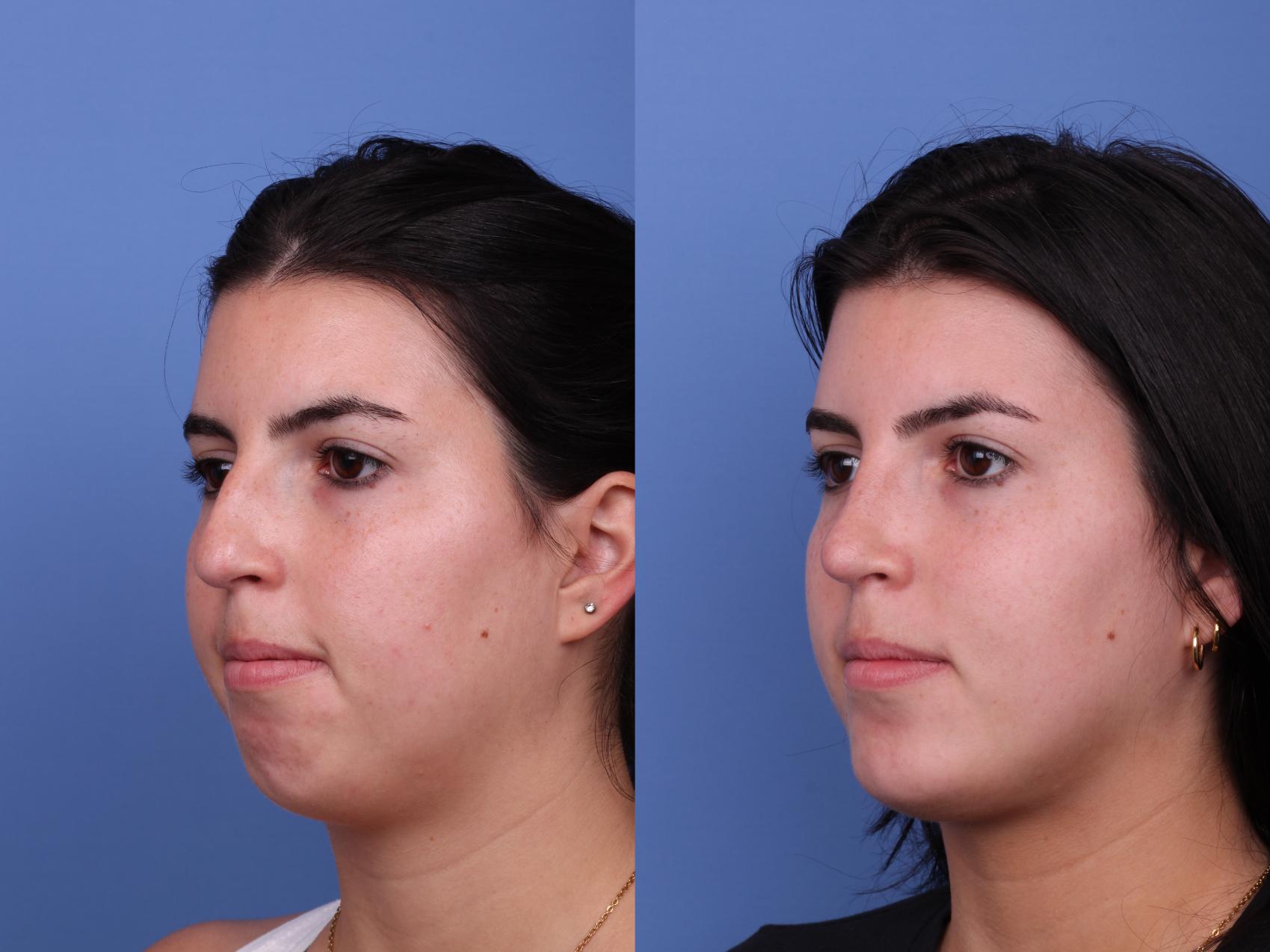 Before & After Rhinoplasty Case 557 Left Oblique View in Scottsdale, AZ