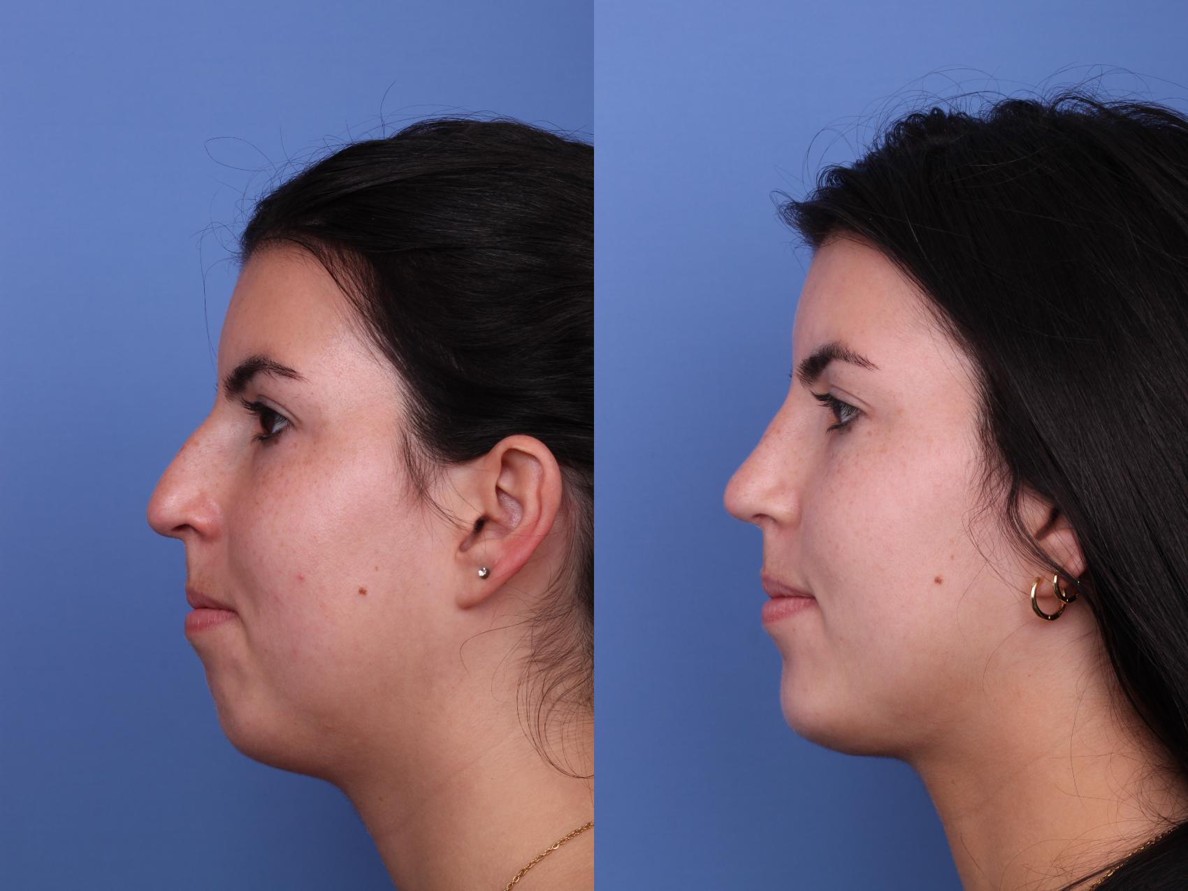 Before & After Rhinoplasty Case 557 Left Side View in Scottsdale, AZ