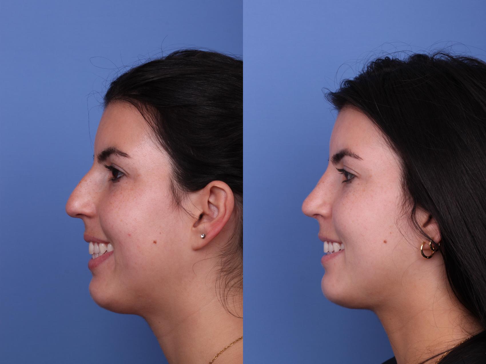 Before & After Rhinoplasty Case 557 Left Smile View in Scottsdale, AZ