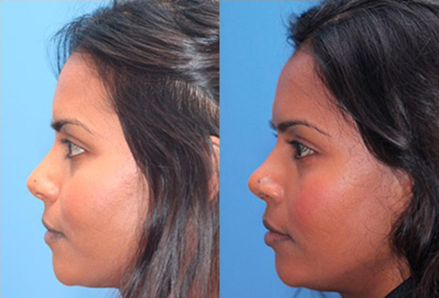 Before & After Rhinoplasty Case 56 View #2 View in Scottsdale, AZ