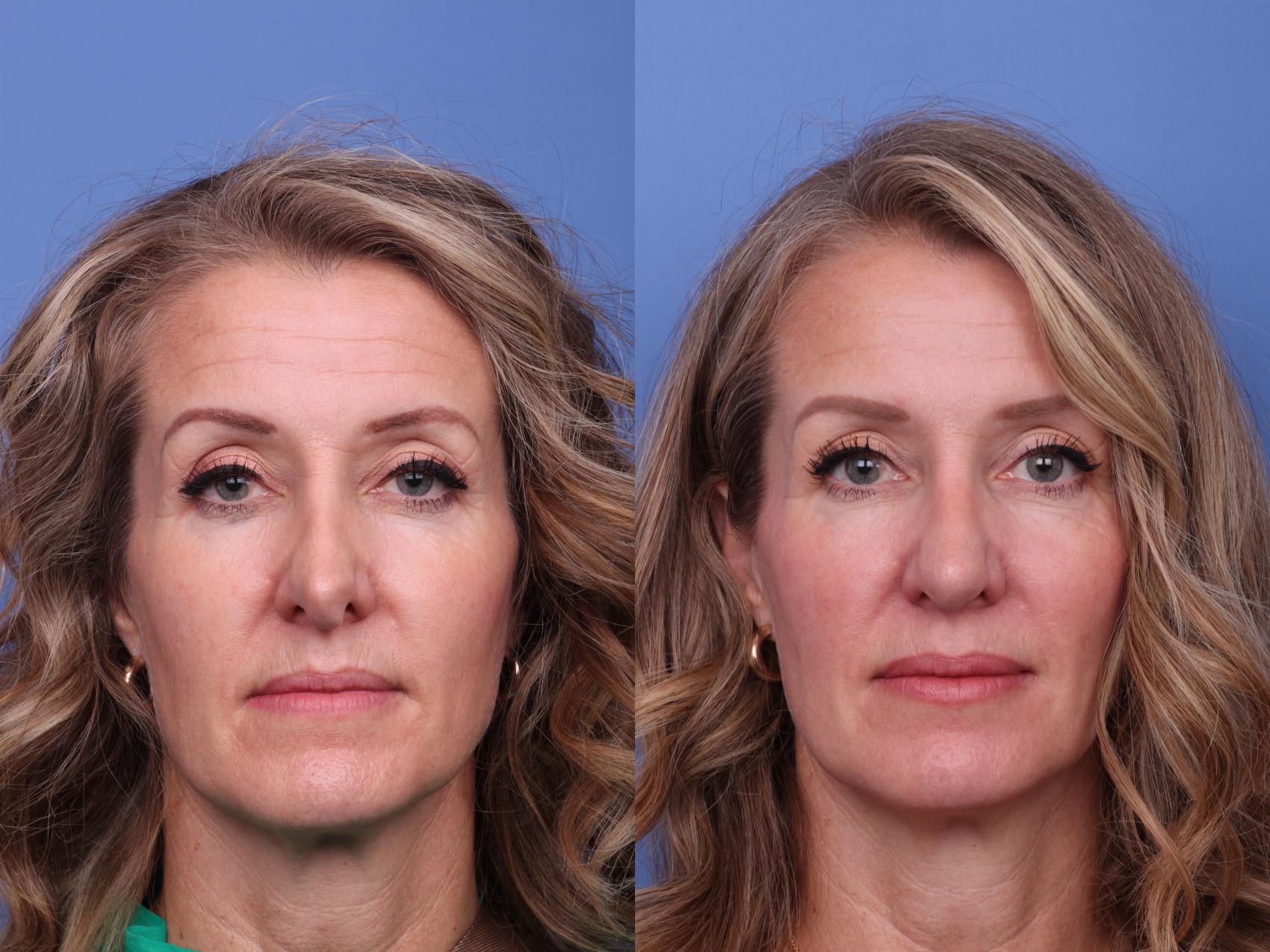 Before & After Rhinoplasty Case 561 Front View in Scottsdale, AZ