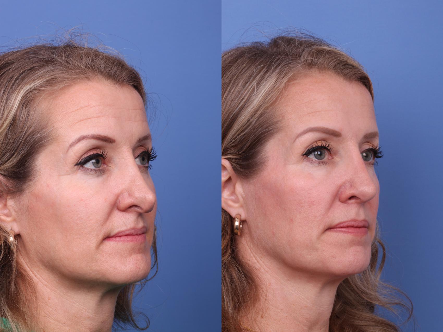 Before & After Rhinoplasty Case 561 Right Oblique View in Scottsdale, AZ