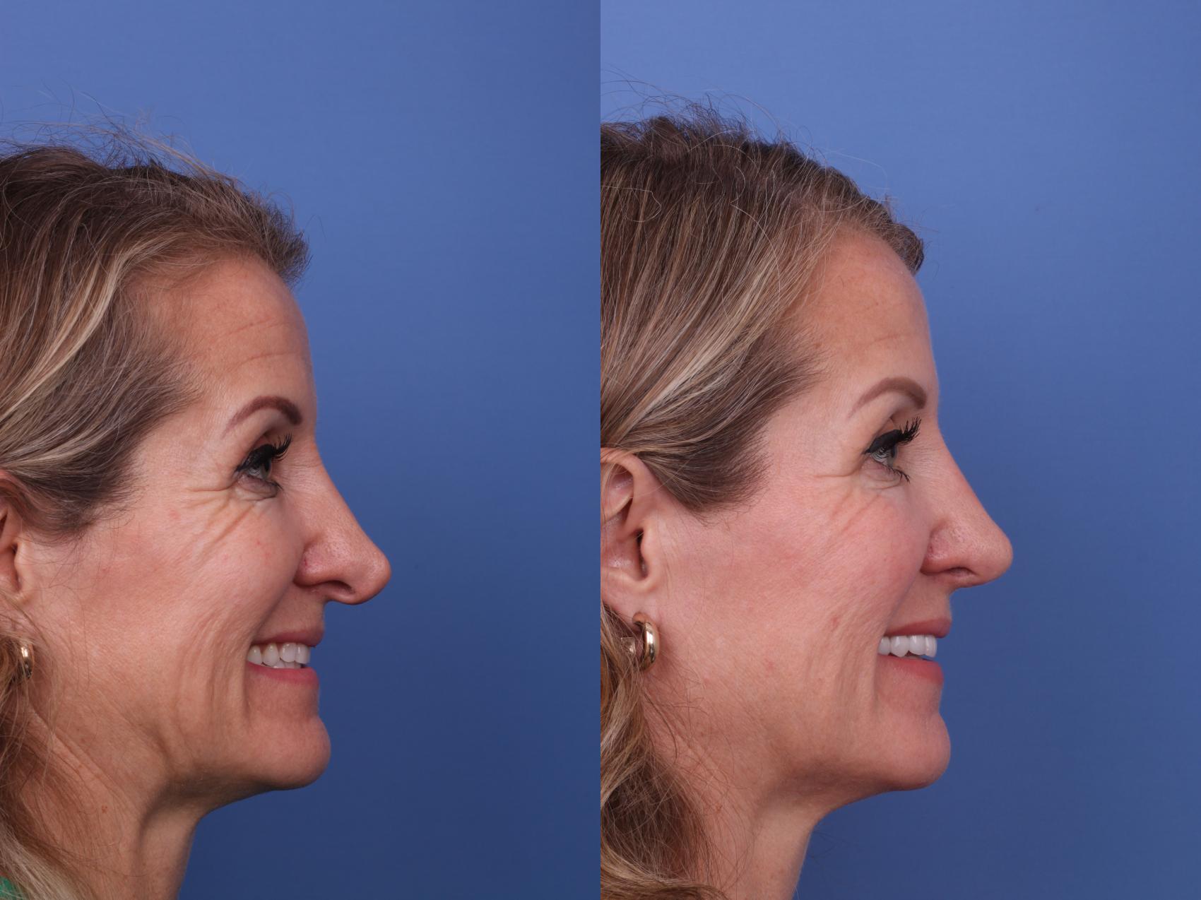 Before & After Rhinoplasty Case 561 Right Smile View in Scottsdale, AZ