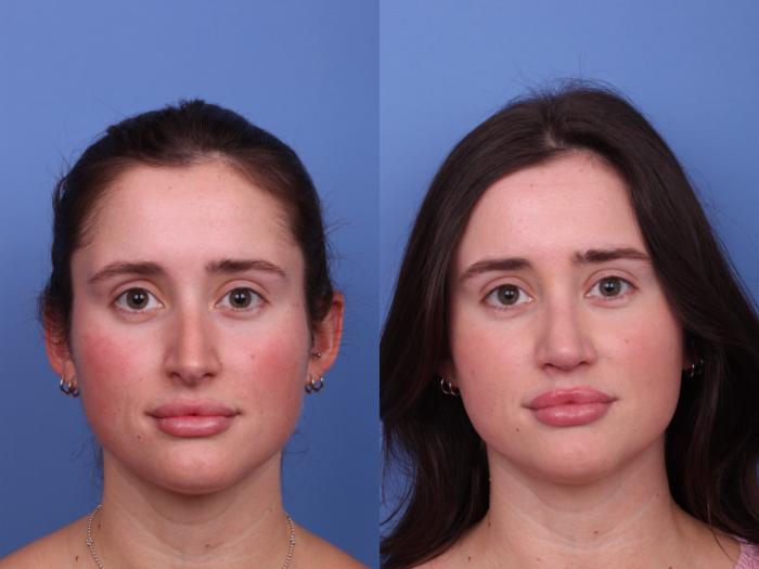 Rhinoplasty Before & After Photo | Scottsdale & Phoenix, AZ | Hobgood Facial Plastic Surgery: Todd Hobgood, MD