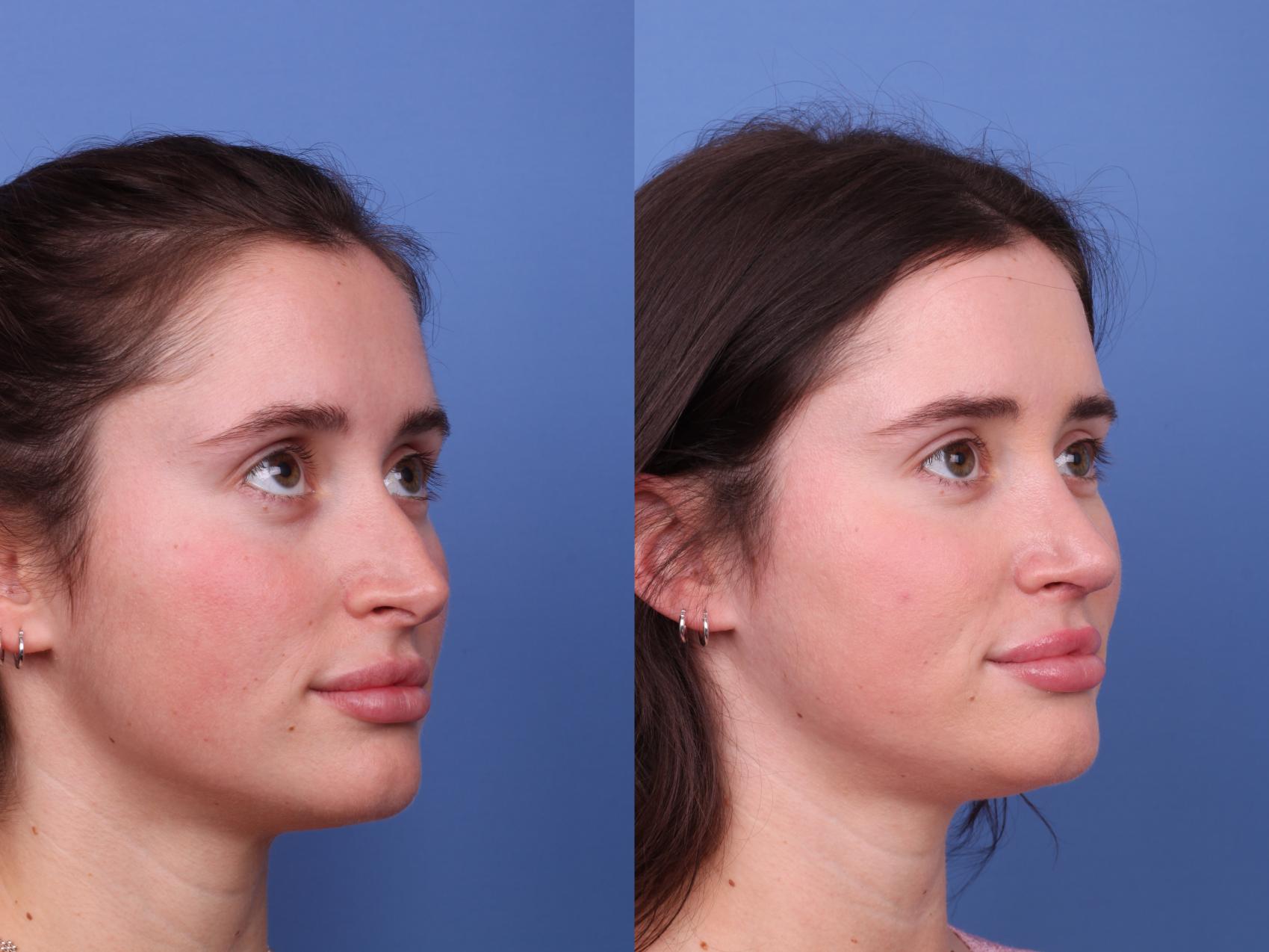 Before & After Rhinoplasty Case 565 Right Oblique View in Scottsdale, AZ