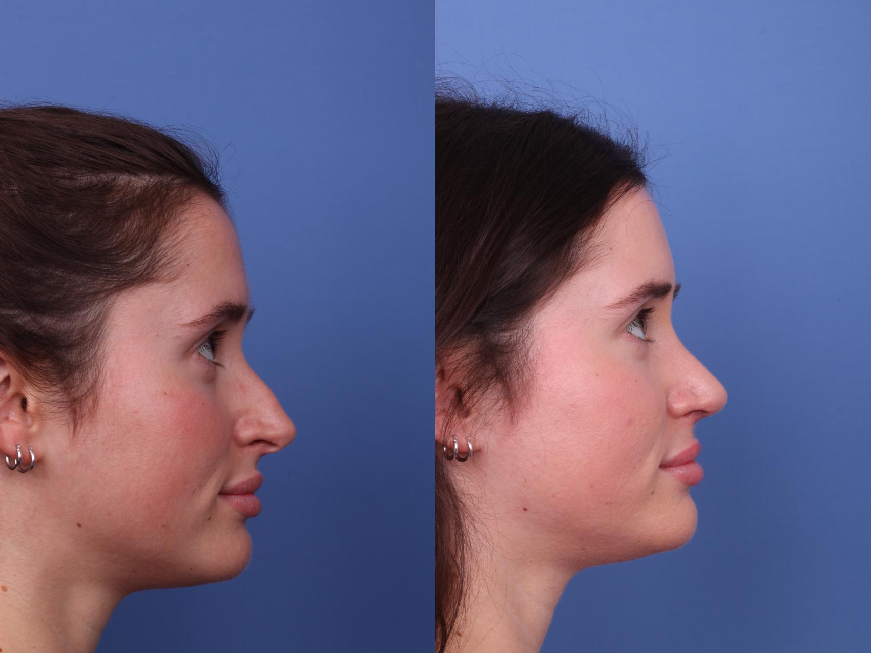 Before & After Rhinoplasty Case 565 Right Side View in Scottsdale, AZ