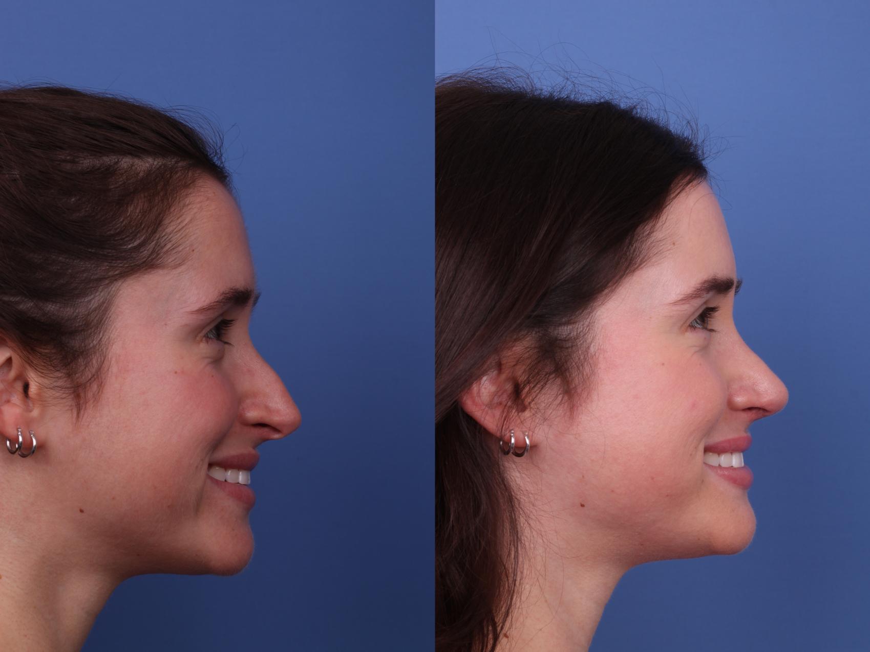 Before & After Rhinoplasty Case 565 Right Smile View in Scottsdale, AZ