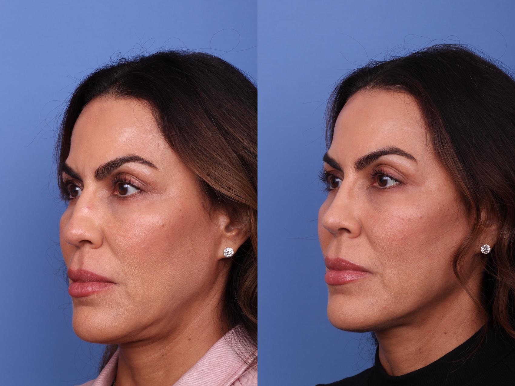 Rhinoplasty Before & After Photo | Scottsdale & Phoenix, AZ | Hobgood Facial Plastic Surgery: Todd Hobgood, MD