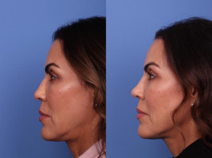 Rhinoplasty Before & After Photo | Scottsdale & Phoenix, AZ | Hobgood Facial Plastic Surgery: Todd Hobgood, MD