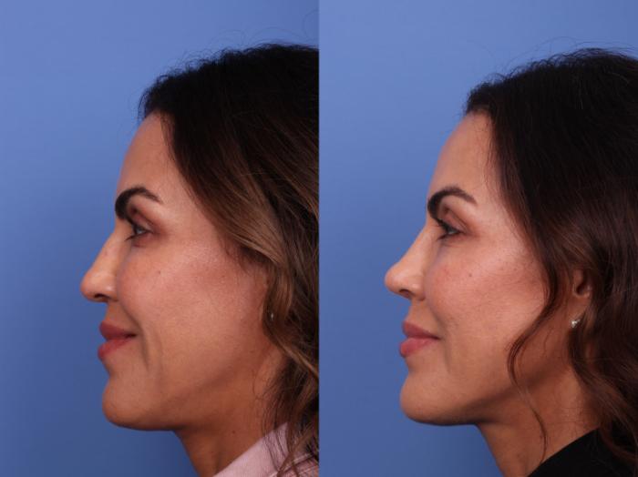 Rhinoplasty Before & After Photo | Scottsdale & Phoenix, AZ | Hobgood Facial Plastic Surgery: Todd Hobgood, MD