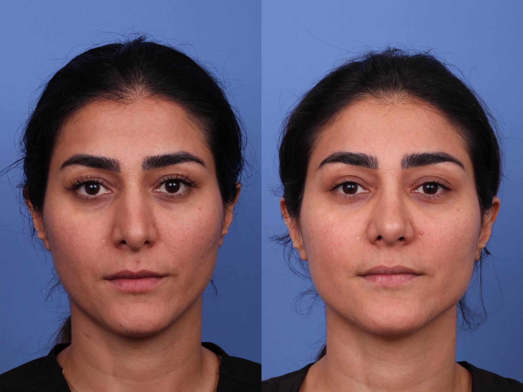 Before & After Rhinoplasty Case 569 Front View in Scottsdale, AZ