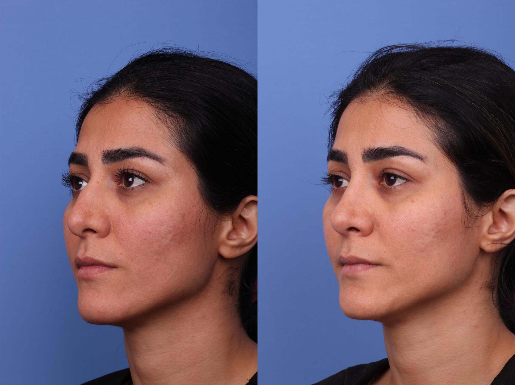 Before & After Rhinoplasty Case 569 Left Oblique View in Scottsdale, AZ
