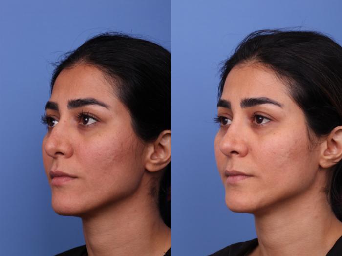 Rhinoplasty Before & After Photo | Scottsdale & Phoenix, AZ | Hobgood Facial Plastic Surgery: Todd Hobgood, MD