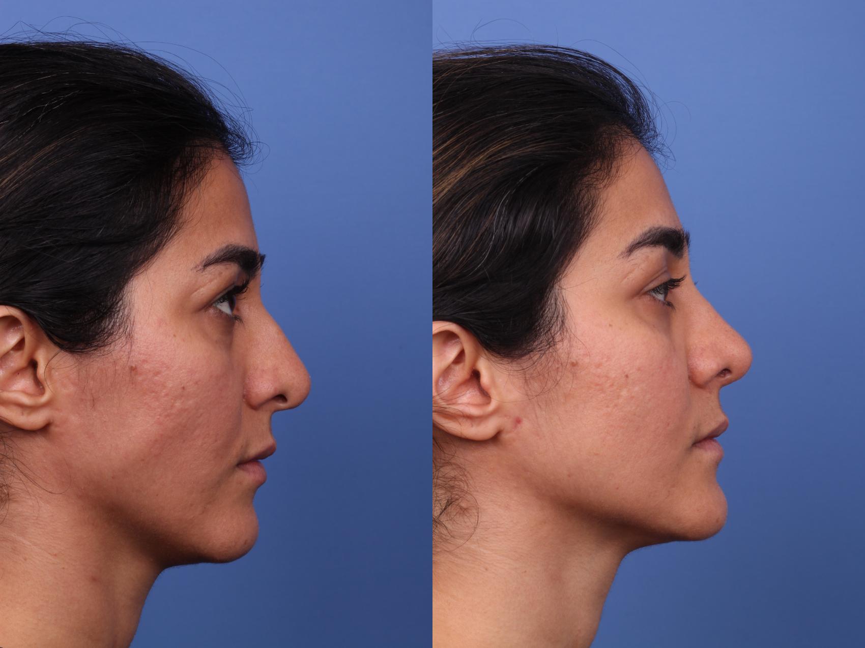 Before & After Rhinoplasty Case 569 Right Side View in Scottsdale, AZ
