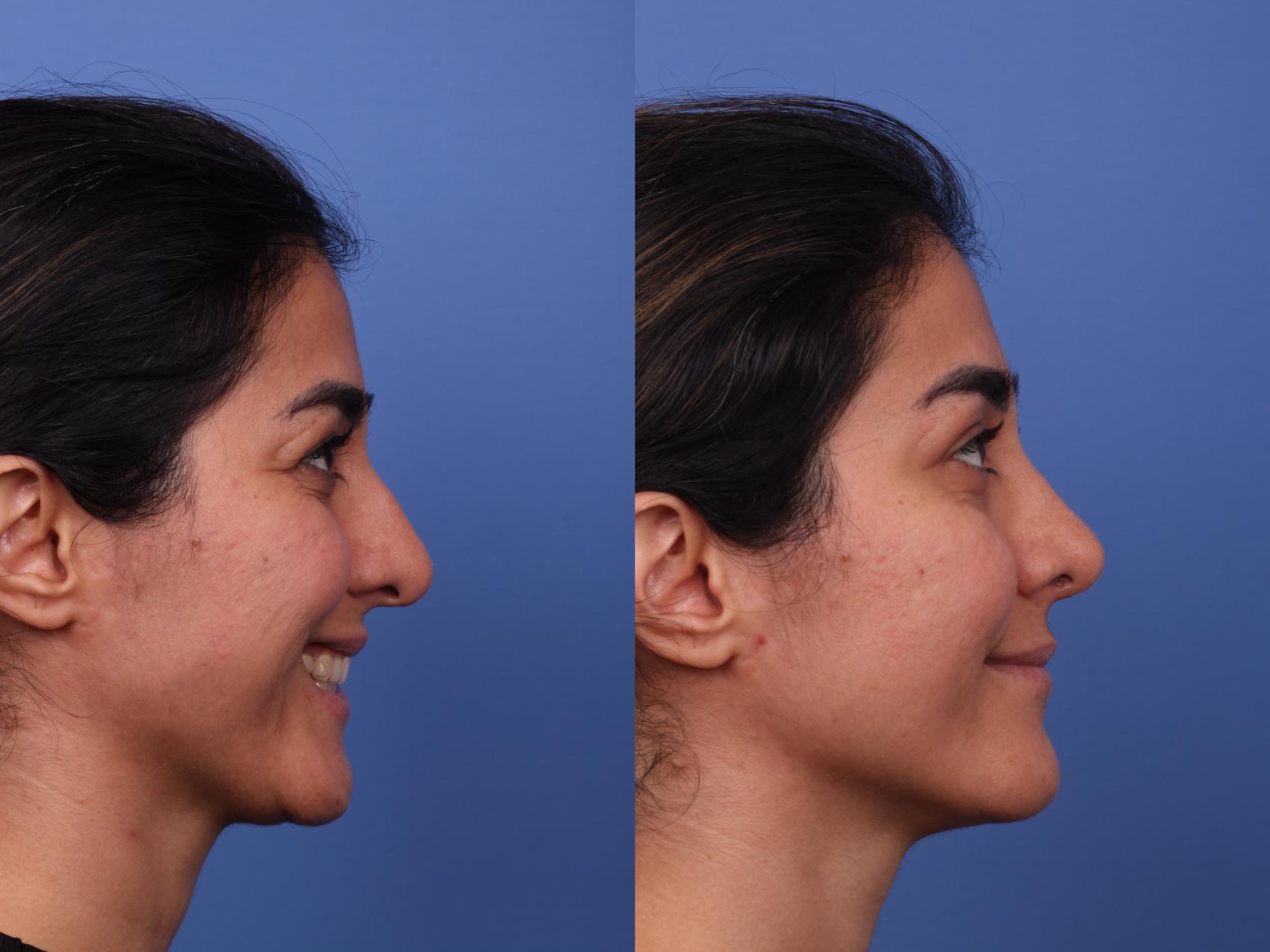 Rhinoplasty Before & After Photo | Scottsdale & Phoenix, AZ | Hobgood Facial Plastic Surgery: Todd Hobgood, MD