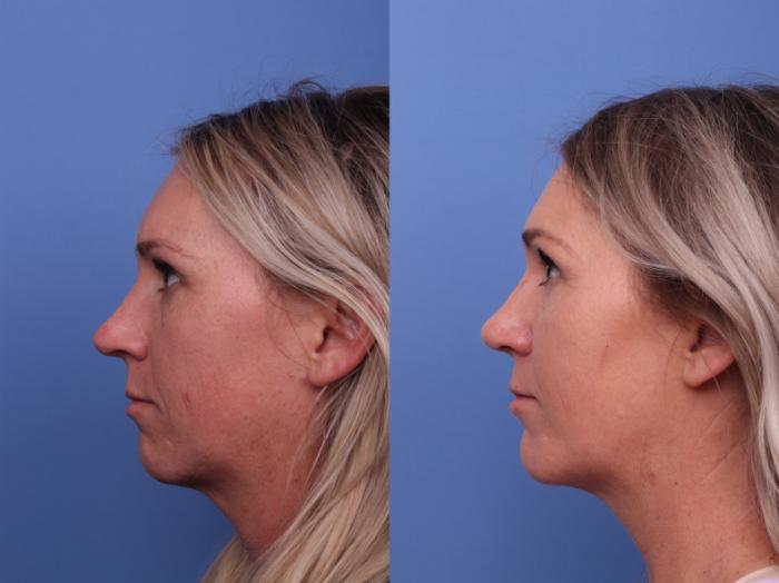 Rhinoplasty Before & After Photo | Scottsdale & Phoenix, AZ | Hobgood Facial Plastic Surgery: Todd Hobgood, MD