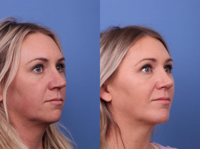 Rhinoplasty Before & After Photo | Scottsdale & Phoenix, AZ | Hobgood Facial Plastic Surgery: Todd Hobgood, MD