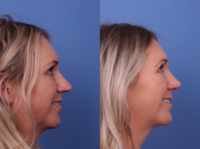 Rhinoplasty Before & After Photo | Scottsdale & Phoenix, AZ | Hobgood Facial Plastic Surgery: Todd Hobgood, MD