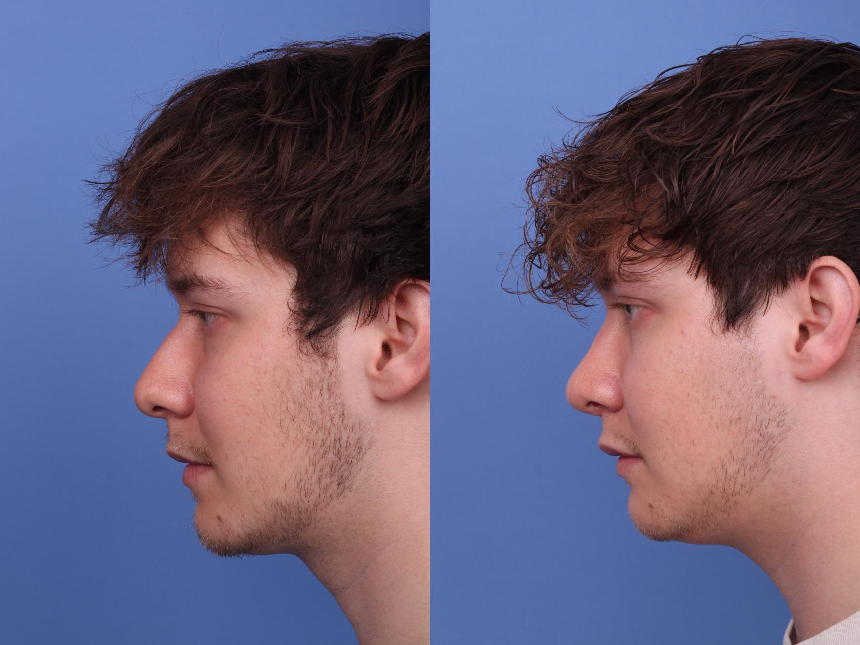 Before & After Rhinoplasty Case 573 Left Side View in Scottsdale, AZ