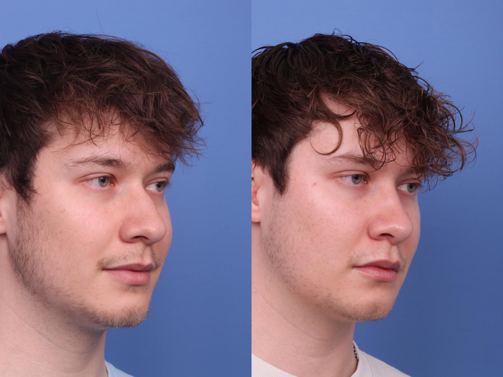 Before & After Rhinoplasty Case 573 Right Oblique View in Scottsdale, AZ