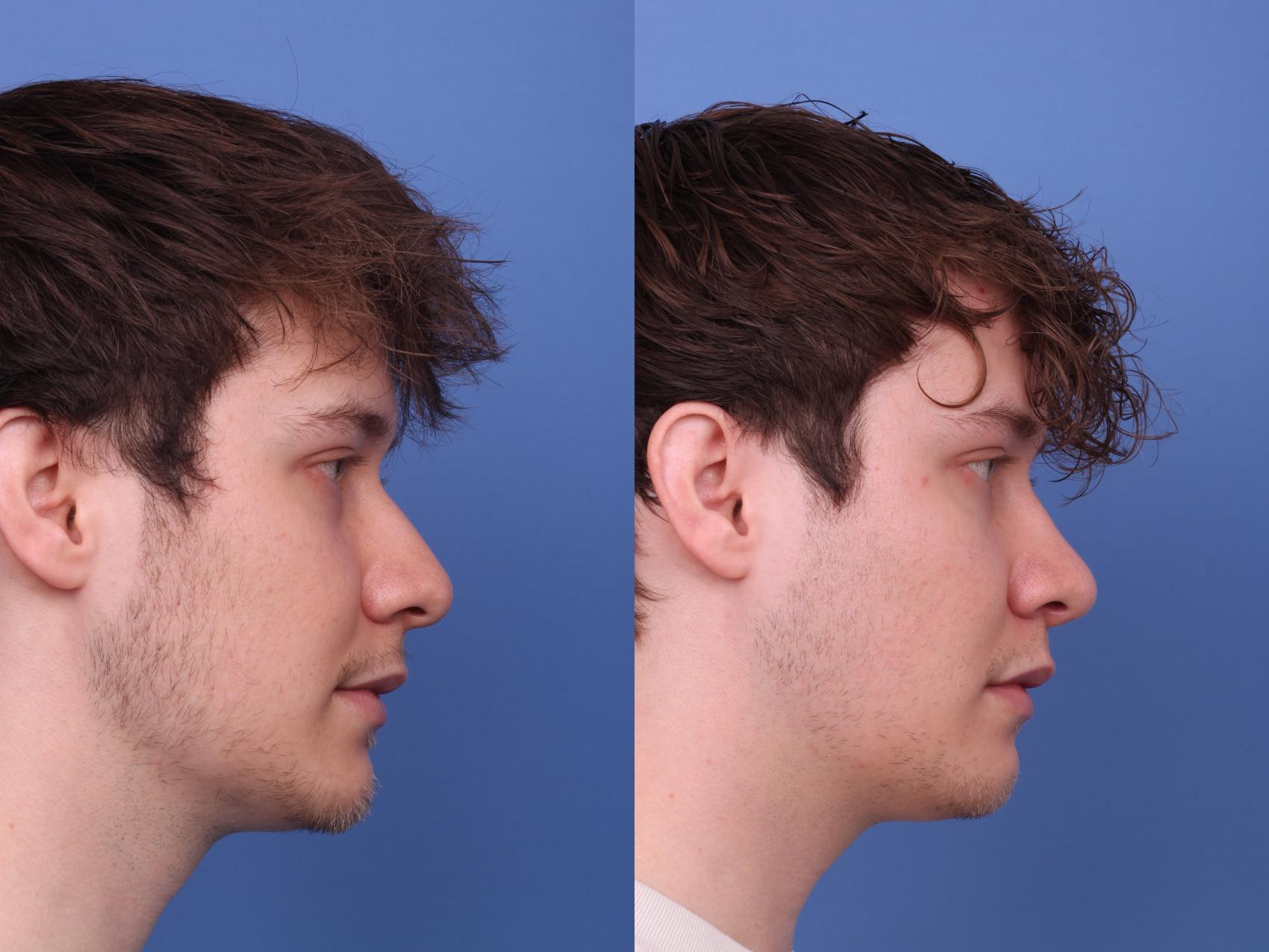 Before & After Rhinoplasty Case 573 Right Side View in Scottsdale, AZ