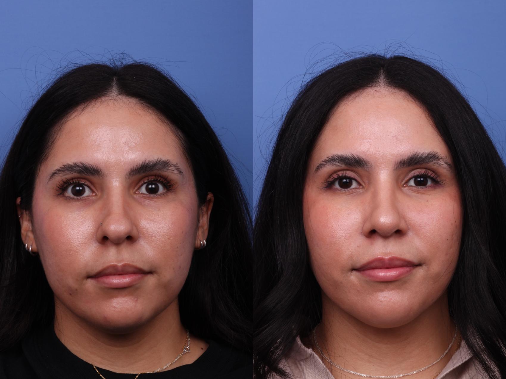 Before & After Rhinoplasty Case 576 Front View in Scottsdale, AZ
