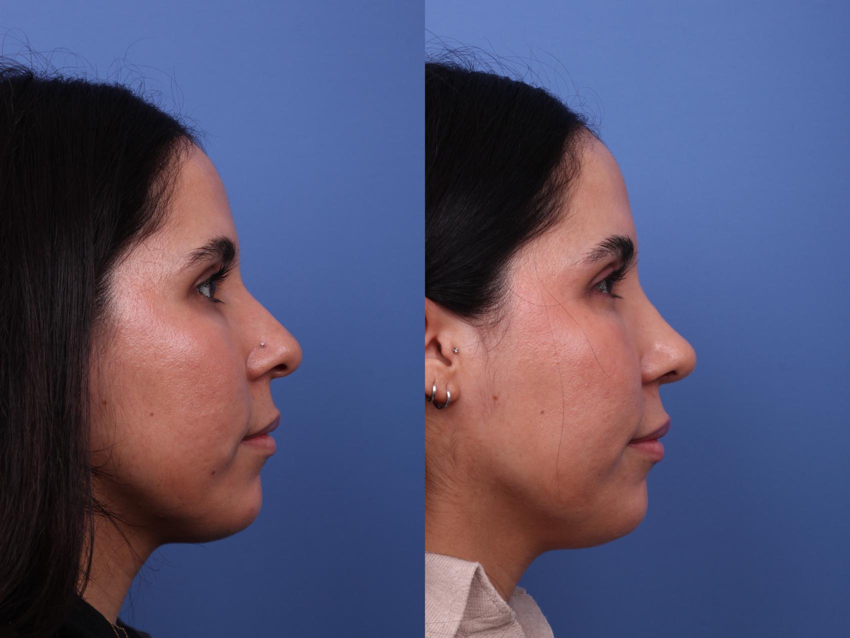 Rhinoplasty Before & After Photo | Scottsdale & Phoenix, AZ | Hobgood Facial Plastic Surgery: Todd Hobgood, MD